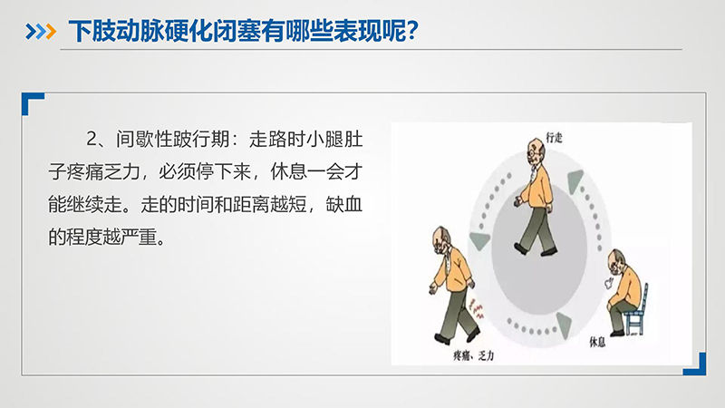 健康科普—下肢动脉硬化闭塞症_08.jpg