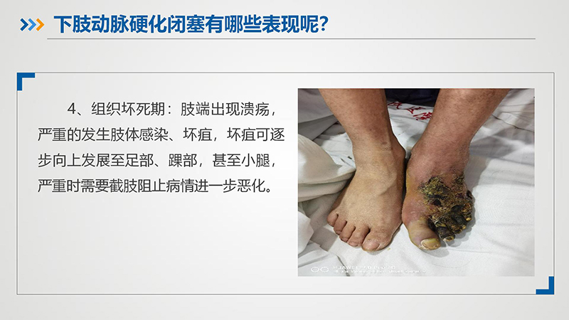 健康科普—下肢动脉硬化闭塞症_10.jpg