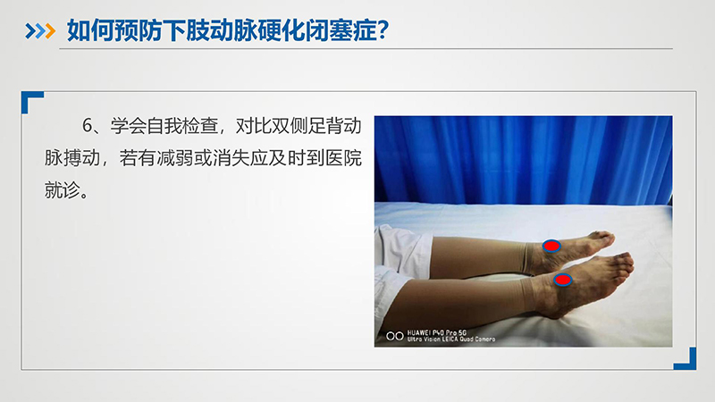 健康科普—下肢动脉硬化闭塞症_16.jpg