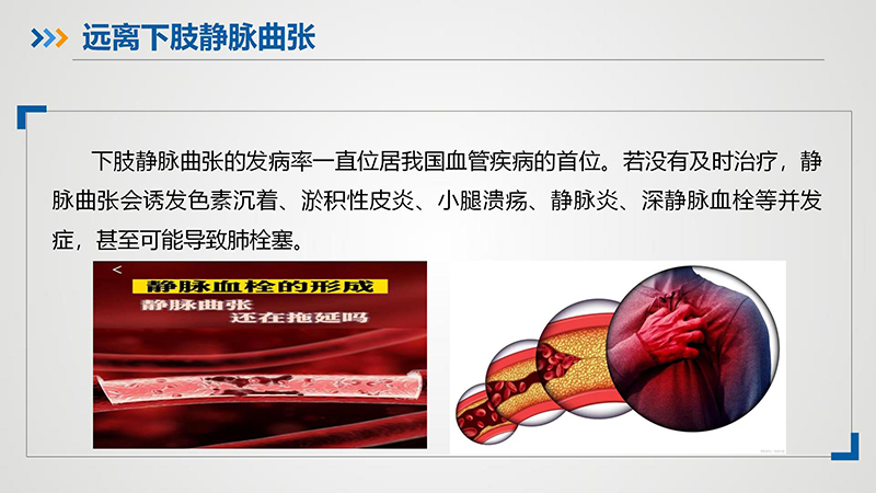 健康科普—下肢静脉曲张_03.jpg
