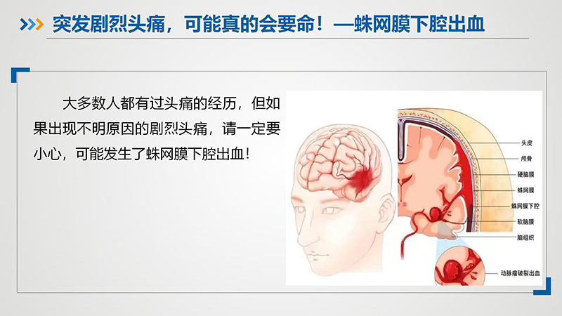 健康科普—蛛网膜下腔出血_02.jpg