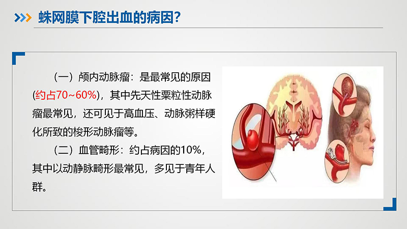 健康科普—蛛网膜下腔出血_11.jpg