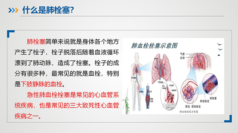 “沉默杀手”—肺栓塞_05.jpg