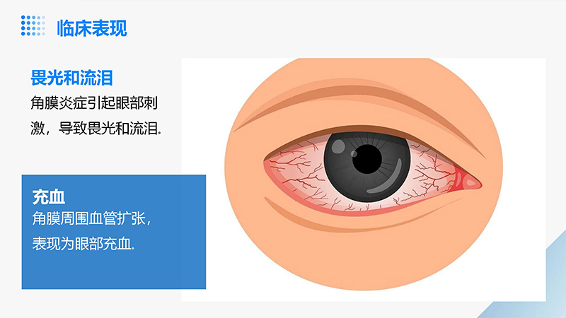 角膜炎的健康宣教ppt.pptx_06.jpg