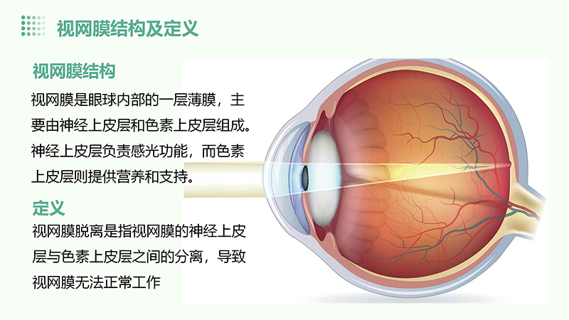 视网膜脱离的健康宣教.pptx(1)_04.jpg