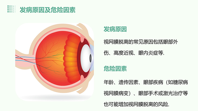视网膜脱离的健康宣教.pptx(1)_05.jpg